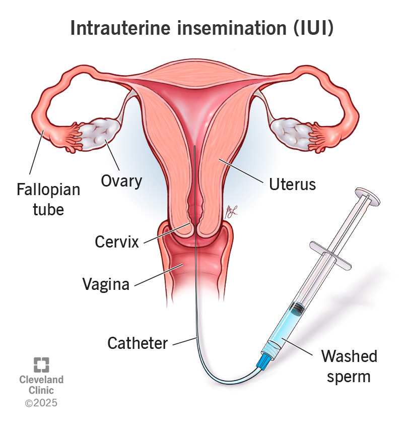 Intrauterine Insemination IUI Medical Procedure Diagram